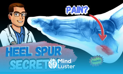 BEST Heel Spur Treatment Heel Spur Removal Stretches Massage