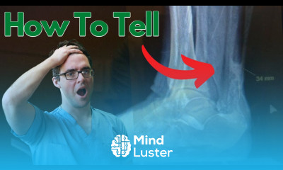 Torn Achilles Tendon Rupture or Achilles Tendonitis HOW TO TELL