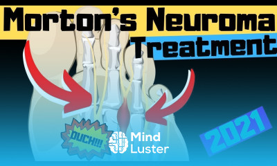 11 BEST Mortons Neuroma Massage Exercise Stretch Treatments WOW