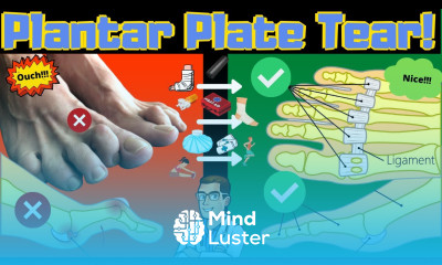 Plantar Plate Tear Treatment Fix a Torn Plantar Plate
