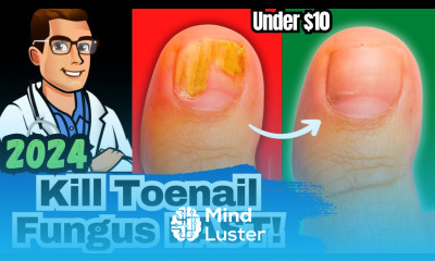 1 NEW Best Toenail Fungus Treatments Medications vs Creams vs Laser