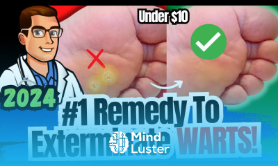 1 BEST Plantar Wart Removal How To Get Rid of Warts Treatments