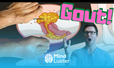 Gout ATTACK Gout Big Toe Joint TREATMENT 2022 Gout FOOT Treatment