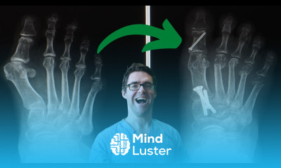 6 Best Bunion Surgery Pros Cons Get the FASTEST Recovery Time