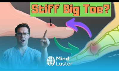 Stiff Big Toe Joint Arthritis Cure Hallux Rigidus Treatment 2024