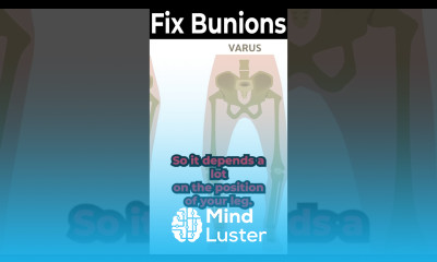 What Causes Bunions on Feet FOR REAL What are Bunions REALLY