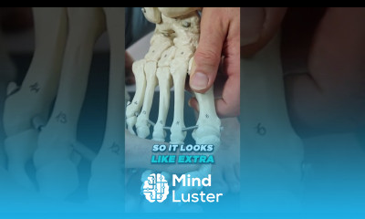 A BUNION a foot Bunion