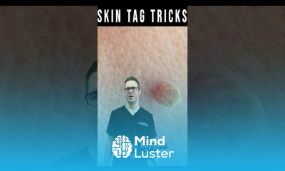 Skin Tag Removal Plantar Wart Removal Garlic Iodine Cider