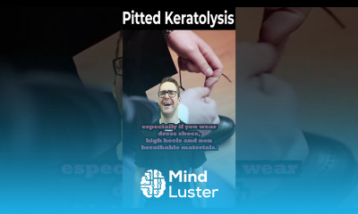 How To Get Rid of Pitted Keratolysis ONCE FOR ALL