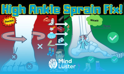 High Ankle Sprain Treatment Causes Exercises Recovery Time