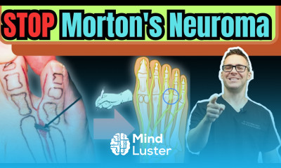 CURE Morton s Neuroma Metatarsalgia Ball of the Foot Pain FAST