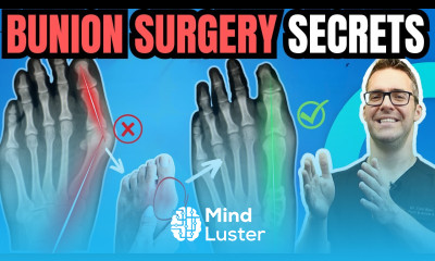 Bunion Surgery SECRETS FAST Recovery Bunionectomy vs Lapiplasty