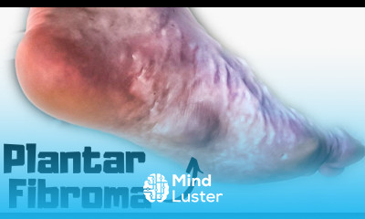 Plantar Fibroma Home Treatment BEST Exercises Remedies 2024