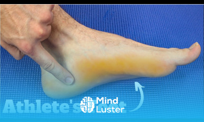 Athlete s Foot Fungus BEST Home Remedies Treatment 2022