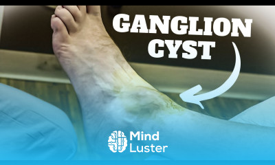 HUGE Ankle Ganglion Cyst Aspiration Surgery Foot Ankle Treatment