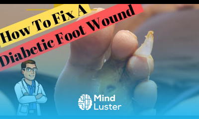The FAST Diabetic Foot Ulcer Fix Type 2 Diabetes Neuropathy