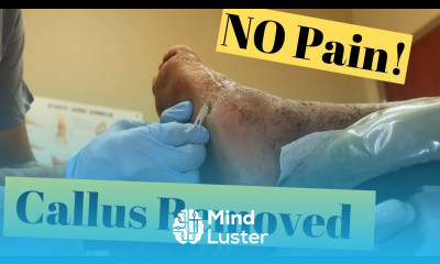 Best Toe Foot Callus Treatment Man Has A Huge Callus Removed