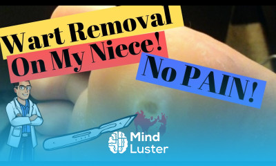 Plantar Wart Removal How to Get Rid of a Foot Wart with No PAIN