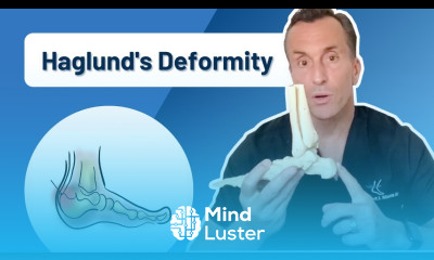 Can Haglund s Deformity Back Of Heel Bump Go Away On Its Own