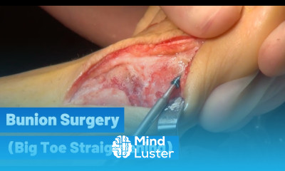 Bunion Surgery Big Toe Straightening with Headless Screw
