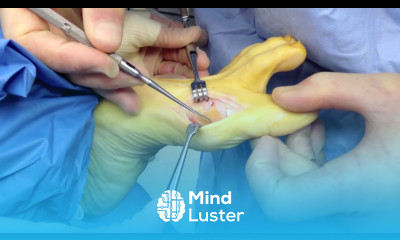 Bunion Correction Surgery Houston Foot Surgeon Dr Robert Moore