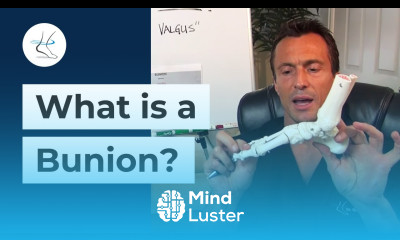 What is a Bunion What Causes Bunions Ask Dr Moore