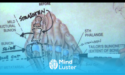 How Do You Fix a Bunionette Tailor s Bunion Dr Moore Explains