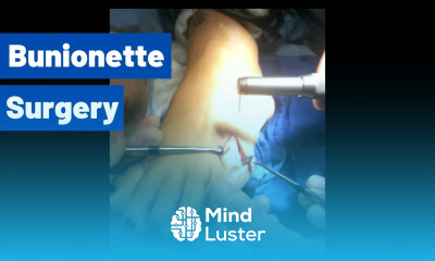 Bunionette Surgery Tailor s Bunion Moore Foot Ankle Specialists