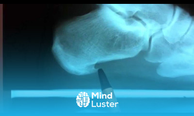 Heel Spur Plantar Fasciitis Surgery Heel Pain Treatments