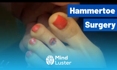 Hammertoe Surgery Toe Shortening and Straightening Dr Moore s Technique w Inion Pin