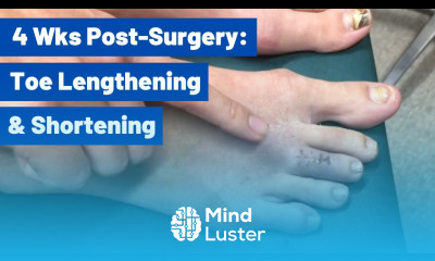 Short Toe Lengthening and Long Toe Shortening 4 weeks Post Surgery Testimonial
