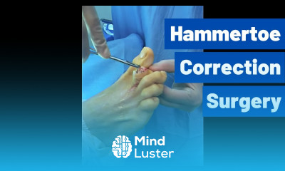 Hammertoe Correction Surgery Using a Smart Toe Implant Moore Foot and Ankle Specialists