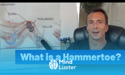 What is a Hammertoe Ask Dr Moore Houston Foot Ankle Surgeon