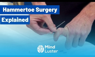 Hammertoe Surgery Explained by Dr Moore Using an Internal Pin
