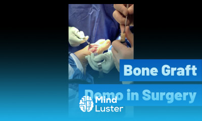 BONE GRAFT DEMO IN SURGERY Houston Foot Surgeon Using TenSIX DBM by Solana Surgical