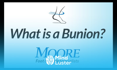 What is a Bunion Causes and Treatment Options