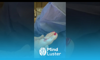 Bunion Surgery with Natural Ossio Fixation