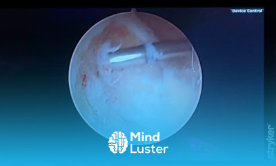 Ankle Arthroscopy Video Dr Moore repairs talar subchondral fracture with Tactoset