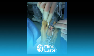 Neuroma Foot Surgery Neuroma Foot Pain Treatments