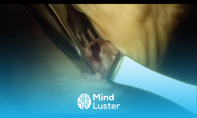 Surgery for Heel Pain Heel Spur Plantar Fasciitis Surgery