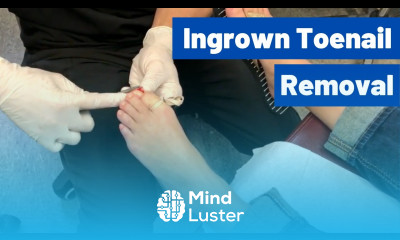 Ingrown Toenail Removal Surgery Video Permanent Cosmetic Procedure