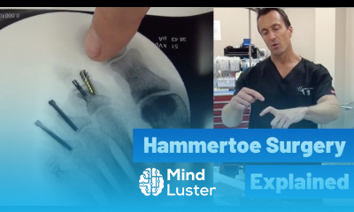 Hammertoe Correction Surgery Explained by Dr Moore Using the Phalinx Hammertoe Fixation System
