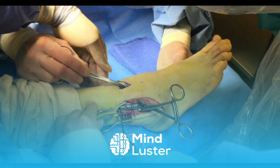 Ankle Fracture Surgery Video Dr Moore Using Stryker VariAx Fibula Plating System