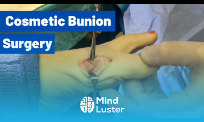 Cosmetic Bunion Surgery Houston Foot Surgeon