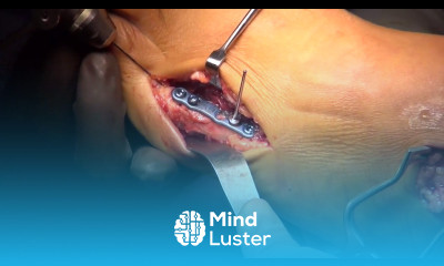 Metatarsal Foot Fracture Surgery Medline Foot Reconstruction System