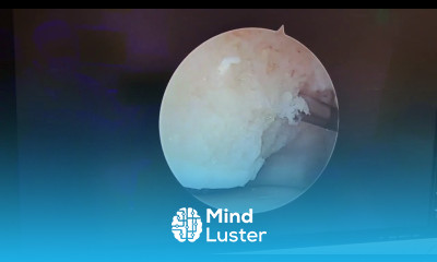 Ankle Arthritis Surgery Video Subchondroplasty with Liquid Bone