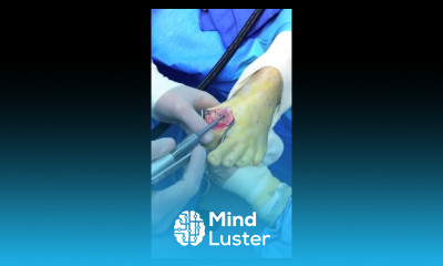 Big Toe Joint Replacement Surgery with Primus Implant Moore Foot and Ankle Specialists