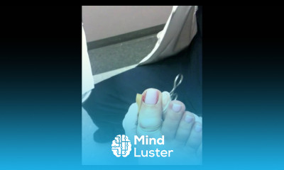 Ingrown Toenail Removal Permanent Treatment Dr Moore Houston Foot Surgeon