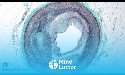 Heart Disease Starts in Childhood