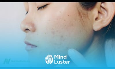 Saving Lives by Treating Acne with Diet